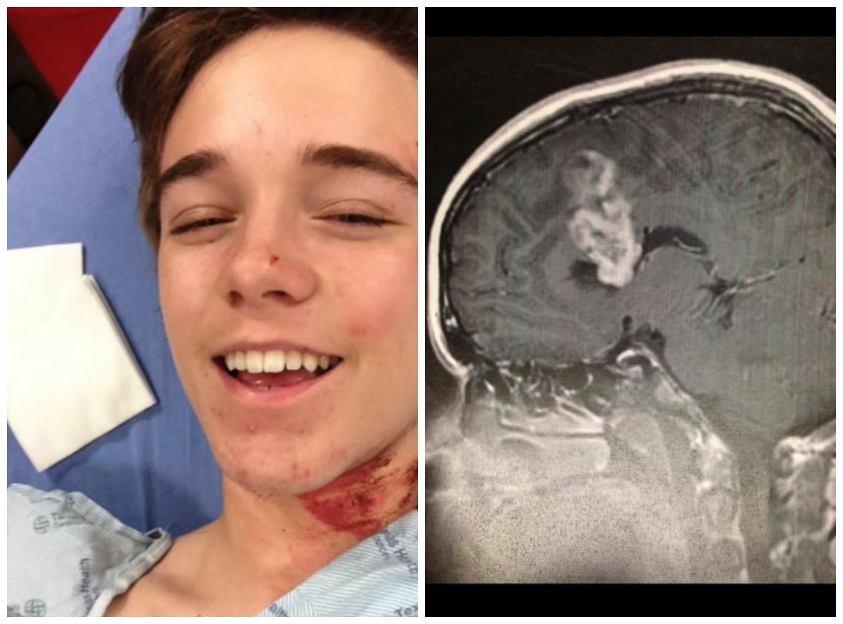 Joven estadounidense descubre que tenia un tumor en el cerebro gracias a un accidente.